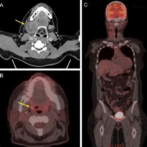 Imaging Findings Pre And Post Surgical A Pre Operative Axial Neck