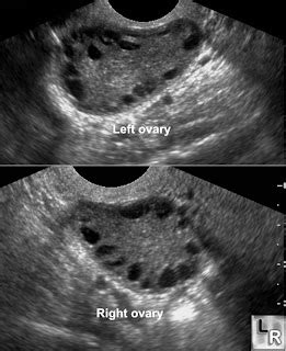 Womens Health: normal ovary ultrasound