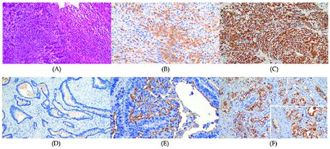 The Immunohistochemical Ihc Stain For Mucin Expression A Diffuse