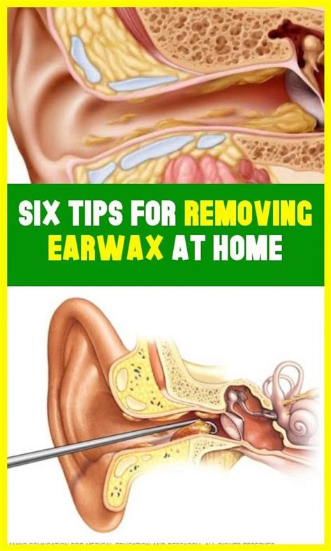 Six Tips For Removing Earwax At Home In 2020 Ear Wax Ear Wax Removal Tips