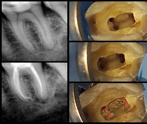 Endodoncia Recomendaciones Y Complicaciones Tras Una Endodoncia