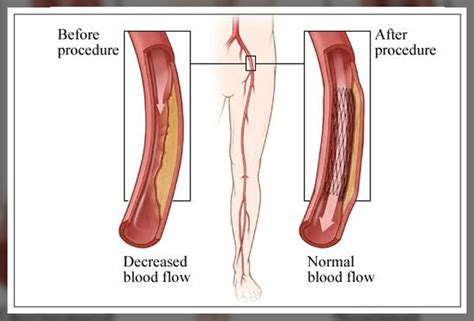 Peripheral Artery Angioplasty Procedure And Stent Placement Engiomed