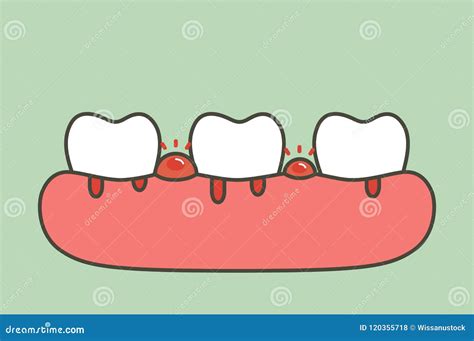 Periodontitis Or Gum Disease With Bleeding Teeth Cartoon Vector Flat