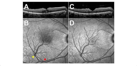 Optical Coherence Tomography Oct Through The Fovea And Infra Red Download Scientific