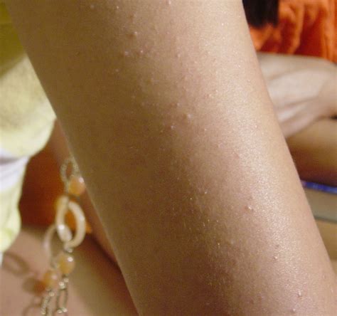 Keratosis Pilaris Kp Is A Skin Condition Effecting Roughly Half Of The Population And