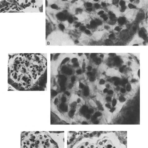 Effect Of A Antibody To Glycated Albumin On Glomerular Histology In