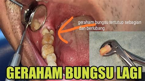 Pencabutan Gigi Geraham Bungsu Bawah Yang Berlubang Dan Tertutup Gusi