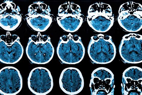 Identifican Un Biomarcador De La Demencia Frontotemporal