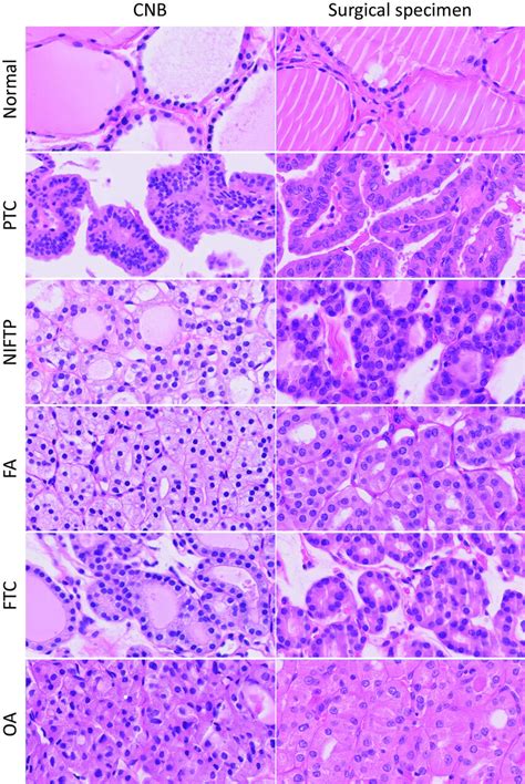 Representative histologic images of thyroid tumors in core needle ...