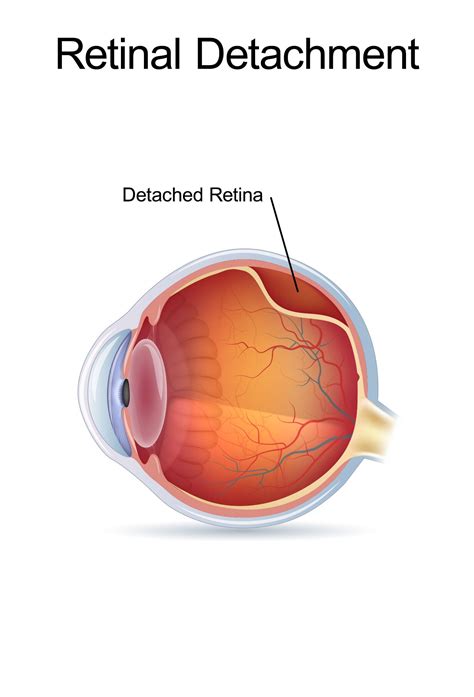 Retinal Detachment Symptoms Monterey Ca