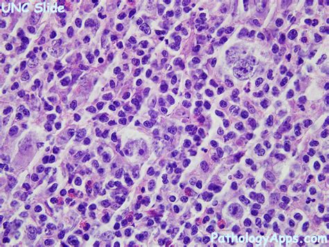 Classic Hodgkin Lymphoma Hematopathology