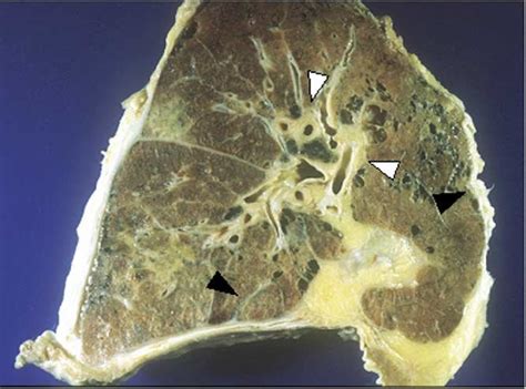 Gross Pathologic Specimen Of A Patient With Pulmonary Lymphangitic Download Scientific Diagram