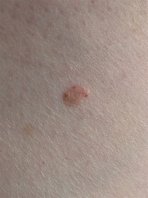 Seborrheic Keratosis R Melanoma