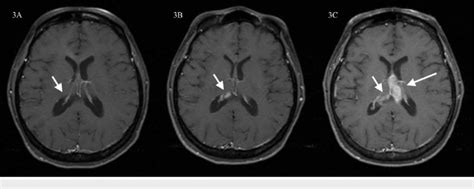 Post Contrast Axial T1 Weighted Image MRI Of The Brain At Two Figure