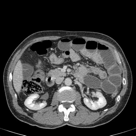 The Radiology Assistant Closed Loop Obstruction In Small Bowel Obstruction