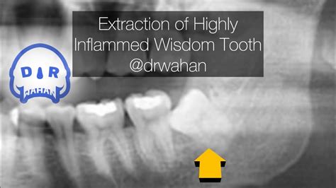 Highly Inflamed Wisdom Tooth Removal Drwahan Youtube