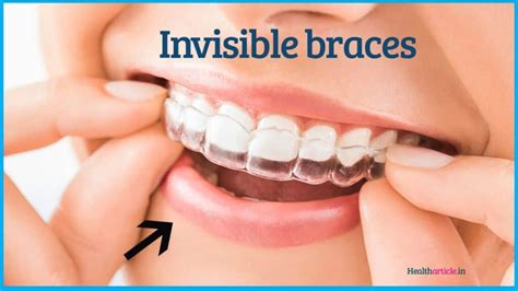 Invisible Braces Cost Advantages And Disadvantages