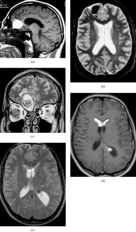 Differential Diagnosis Of Intracranial Lesions With High Signal On T