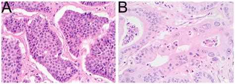 A The Neuroendocrine Tumour Of The Terminal Ileum Exhibited A Typical Download Scientific