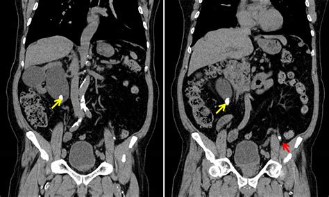 Bilateral Ureteric Calculi Radiology Cases