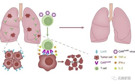 肺癌免疫联合治疗 CAR T竟联手PD 1 新免疫组合治疗首次应用于肺癌 疗效1 1 2 全球肿瘤医生网
