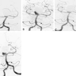 Raymond Classification For Aneurysmal Occlusions Reproduced With