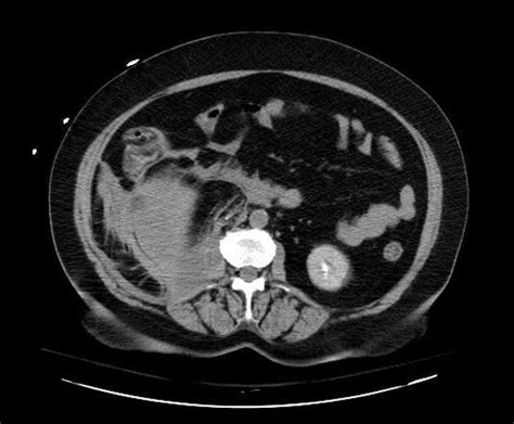 Retroperitoneal Bleed Ultrasound