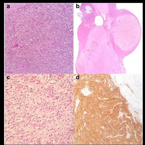 A Ileal Gist Hematoxylin And Eosin Hande Stain Original Magnification