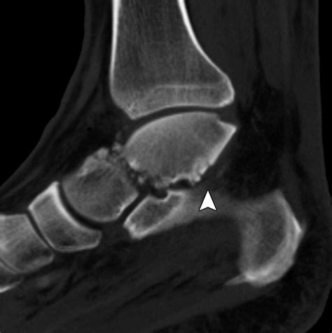 Talar Fractures And Dislocations A Radiologists Guide To Timely