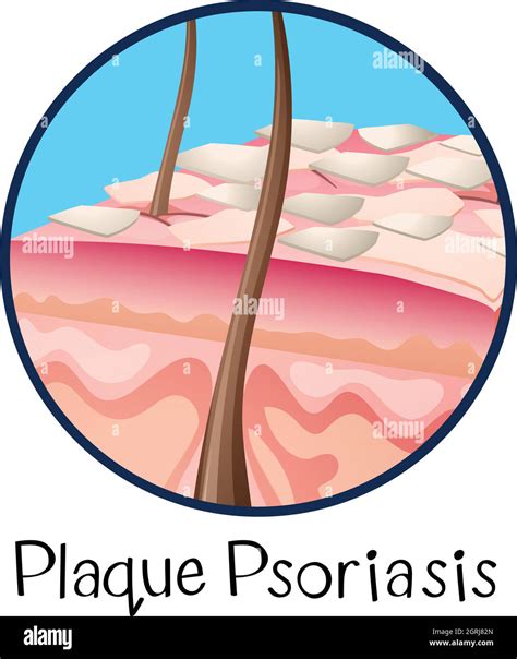 A Human Anatomy Plaque Psoriasis Stock Vector Image Art Alamy