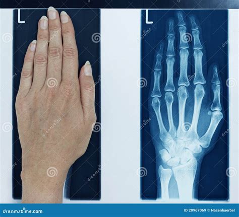 X Ray Picture Left Hand Royalty Free Stock Images Image 20967069
