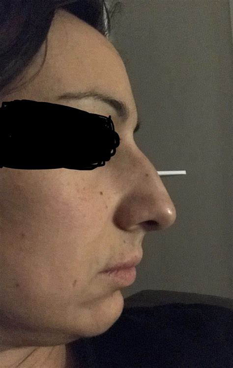 Rhinoplastie M Dicale Possible Rhinoplastie M Dicale Ou Correction