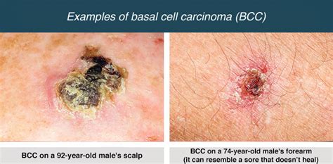 The Least Common Form Of Skin Cancer Is - CancerWalls