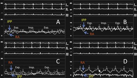 Low Pressure Cardiac Tamponade A Case Report Journal Of Cardiology Cases