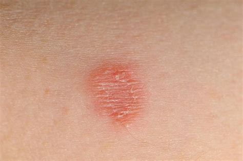 Ringworm in babies: Pictures, treatment, and natural remedies | Home ...