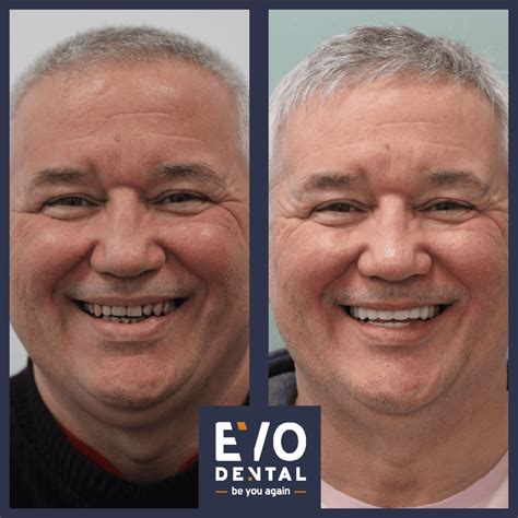 Full Mouth Dental Implants Wolverhampton Evodental