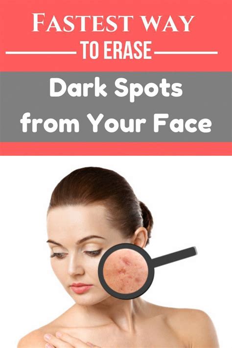 6 Home Remedies To Remove Dark Spots On Face Causes Types Artofit