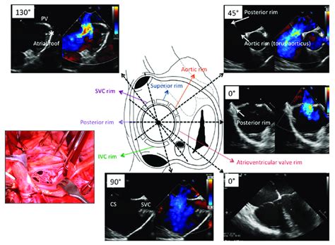 Atrial Septal Defect And Surrounding Borders Right Atrial View Of