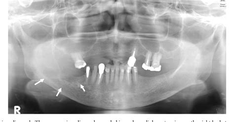 PDF A Case Of Primary Intraosseous Adenoid Cystic Carcinoma Of The