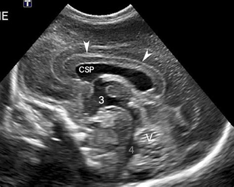 Normal Head Us In A Preterm In Sagittal Plane Through The Midline The