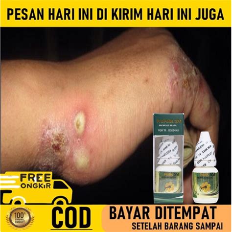 Jual Salep Gudik Obat Gudik Bernanah Obat Scabies Manusia Obat