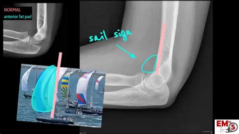 Elbow Anatomy Xray Anatomical Charts Posters