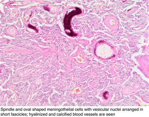 Pathology Outlines Meningioma