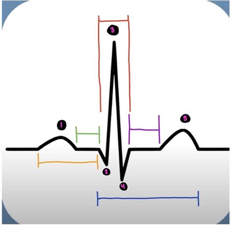 Ekg Graph Flashcards Quizlet