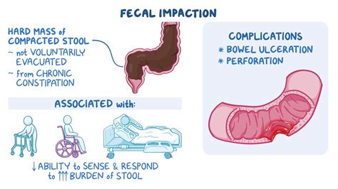 Fecal Impaction