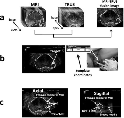 Transperineal Targeted Biopsy With Real Time Fusion Image Of Multiparametric Magnetic Resonance