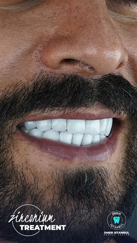 Zirconia Crowns Treatment Affordable Dental Veneers In Turkey Artofit