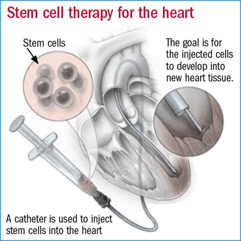 Stem Cells To Repair Heart Damage Not So Fast Harvard Health