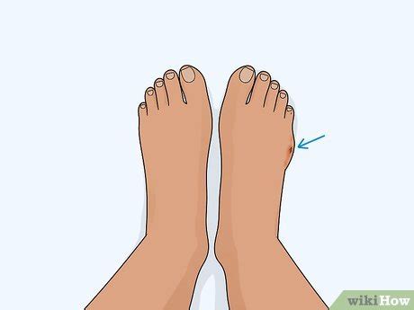 Easy Ways To Heal A Toe Injury Wikihow