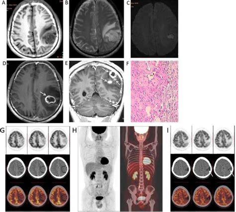 Neuroimaging Findings Of Cerebral Syphilitic Gumma